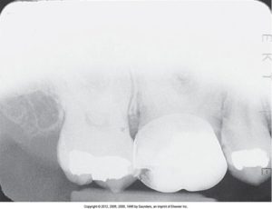 A dental radiograph showing a cone-cut error, where part of the image is missing due to incorrect positioning of the x-ray beam, resulting in an incomplete view of the teeth.