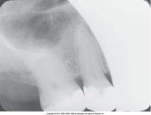 A dental radiograph displaying a cone-cut error with significant underexposure on the right side, resulting in a partially visible and obscured image of the teeth.