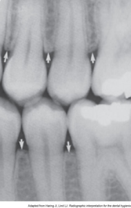 Dental X-ray showing detailed view of several teeth with visible bone levels indicated by arrows.