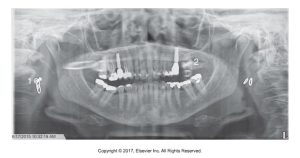 Panoramic dental X-ray showing ghost imaging artifacts, notably the ghost images of dental restorations in the opposite jaw.