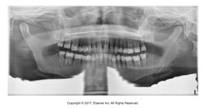 Panoramic dental X-ray displaying a lead apron artifact, characterized by a dense, shadowy area obscuring the neck and lower jaw regions.