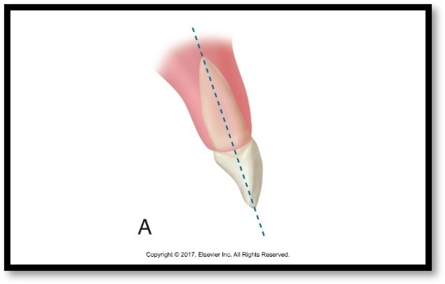 The image shows a diagram labeled "A," depicting a tooth with a highlighted root and a dashed blue line indicating the long axis of the tooth.