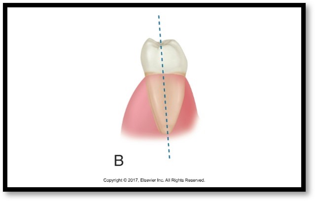 The image shows a diagram labeled "B," depicting a molar tooth with a highlighted root within the gum, and a dashed blue line indicating the long axis of the tooth.