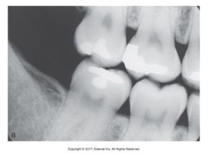 Dental X-ray showing a close-up view of teeth with dental fillings and restorations.