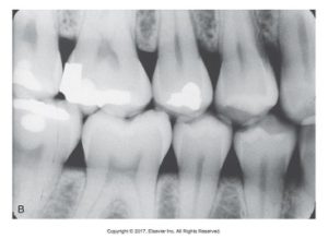 Dental X-ray showing detailed views of multiple teeth with some fillings visible.