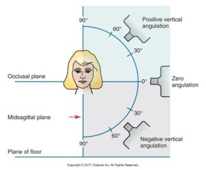 Diagram illustrating vertical angulation in dental radiography, showing angles of X-ray projection relative to the occlusal and midsagittal planes of a patient's head.