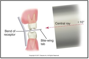 Illustration showing the setup for a bite-wing dental X-ray with a receptor and tab, and the direction of the central ray at +10 degrees.