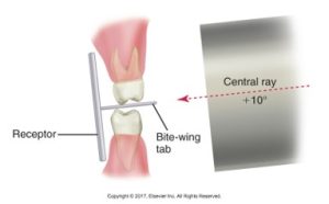 Illustration demonstrating the setup for a dental X-ray using the bite-wing technique with vertical angulation.