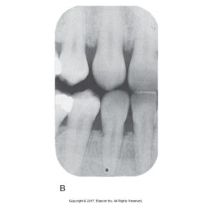 Dental X-ray showing a clear image of several teeth, focusing on their alignment and spacing.