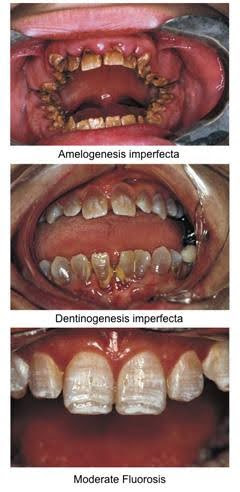 Three clinical photos displaying dental conditions: Top shows Amelogenesis Imperfecta with irregular and discolored enamel; Middle shows Dentinogenesis Imperfecta with translucent and amber-colored teeth; Bottom depicts Moderate Fluorosis with white mottling and staining of the enamel.