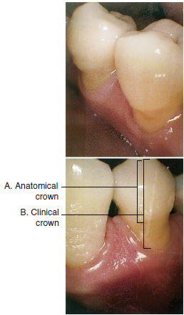 A photograph of teeth displaying the difference between an anatomical crown and a clinical crown, with labeled parts indicating both.