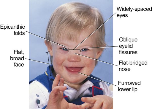 A child with features characteristic of Down syndrome, including epicanthic folds, a flat and broad face, widely-spaced eyes, oblique eyelid fissures, a flat-bridged nose, and a furrowed lower lip.