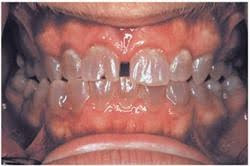 Close-up of a mouth with teeth affected by dentinogenesis imperfecta, showing translucent and discolored teeth with irregular shapes and surfaces.