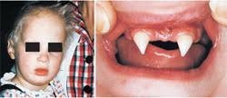 Two images: On the left, a child's face with features of ectodermal dysplasia; on the right, a close-up of a mouth showing abnormal tooth development associated with the condition, with some teeth missing and others shaped irregularly.