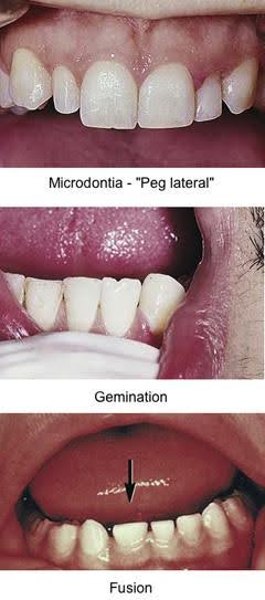 Three clinical photographs showing different dental anomalies: Top photo depicts microdontia with a "Peg lateral" incisor; Middle photo shows gemination with a double crown appearing as one large tooth; Bottom photo illustrates dental fusion with two teeth joined together to form a single structure.