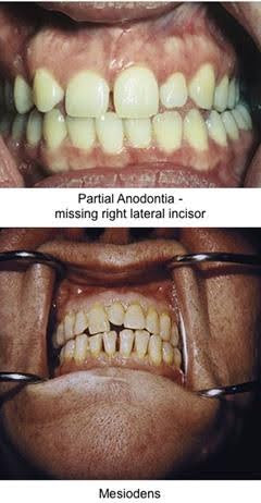 Two clinical photographs of dental conditions: Top shows partial anodontia with the missing right lateral incisor; Bottom shows a case of mesiodens, with an extra tooth located at the midline between the two central incisors.