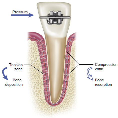 Illustration showing the process of orthodontic tooth movement, with a tooth under pressure from braces, indicating the tension zone with bone deposition and the compression zone with bone resorption.