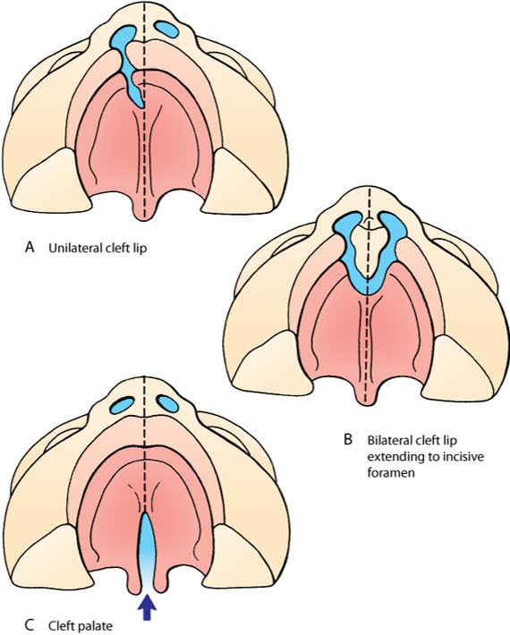 Illustrations of the top view of human oral anatomy demonstrating A) unilateral cleft lip, B) bilateral cleft lip extending to incisive foramen, and C) cleft palate.