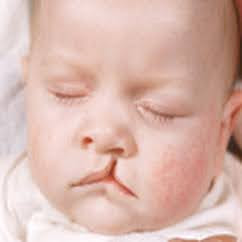 Close-up of a sleeping baby with a cleft lip.