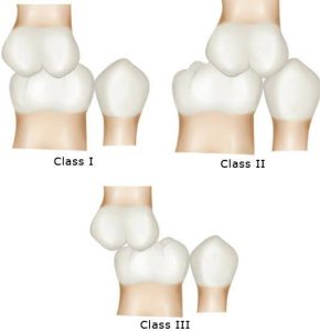 Illustration depicting three different classes of teeth alignment according to Angle's classification: Class I with normal occlusion, Class II with overbite, and Class III with underbite.