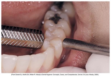 Close-up image of a dental examination assessing the mobility of a tooth with a large cavity, using dental tools to check stability.