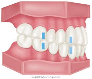 Illustration of a human dental arch showing a healthy occlusion with marked areas on several teeth indicating points of interest for dental examination or treatment.