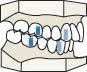 Cartoon-style illustration of a human dental arch with a Class II Division 2 malocclusion, characterized by upper front teeth tilted inward while the back teeth maintain normal alignment.