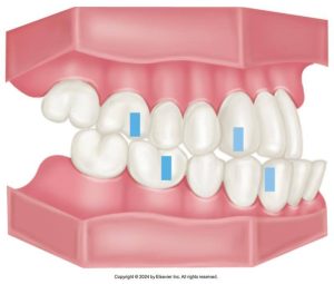 Illustration of a human dental arch with Class III malocclusion, showing underbite where the lower teeth protrude past the upper teeth, with blue markers on specific teeth indicating areas of focus