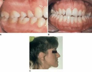 Three images illustrating Class III malocclusion: A) Close-up of the lower jaw showing underbite, B) Front view of open mouth with lower teeth protruding beyond upper teeth, and C) Side profile of a woman with her eye area blacked out to show the facial impact of the underbite.