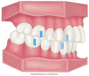 "Illustration of a human dental arch with an overbite condition, showing upper teeth significantly overlapping the lower teeth, highlighted with blue markers on specific teeth for detailed study.