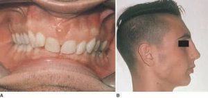 Two images showing Class II Division 2 dental malocclusion: A) A frontal view of an open mouth displaying upper front teeth tilted inward, and B) A side profile of a young male with his eye area blacked out for privacy.