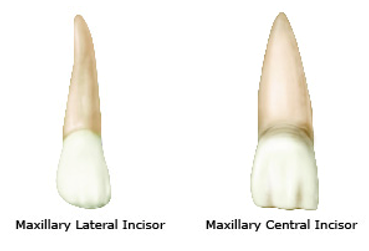 Illustration comparing the shapes of a maxillary lateral incisor and a maxillary central incisor from the lingual perspective, highlighting differences in contour and size.