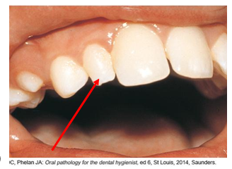 Close-up image of a person's smile focusing on the maxillary lateral incisor with an arrow indicating a specific feature or condition on the tooth.