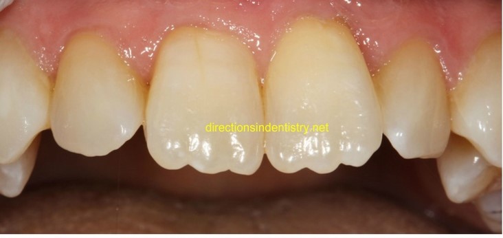 Close-up image of a person's smile showing newly erupted maxillary front teeth with varying degrees of translucency and slight yellowing.