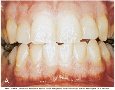 Close-up image of a person's open mouth showing the front teeth and gums, with signs of mild gingival inflammation and dental plaque visible.