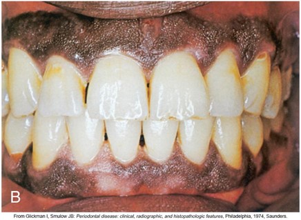 Close-up image of a dark-skinned person's open mouth showing well-maintained front teeth with bright white crowns, highlighting dental health and cosmetic dentistry results.