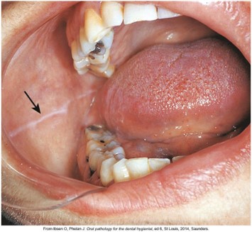 Close-up image of the inside of a mouth showing a view of the tongue, lower teeth, and the buccal mucosa, highlighting the normal variations with a visible arrow pointing to a specific area of interest.