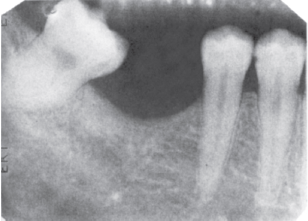 Dental X-ray showing multiple teeth with clear visualization of the roots and surrounding bone structure, used for diagnostic purposes in dental health.