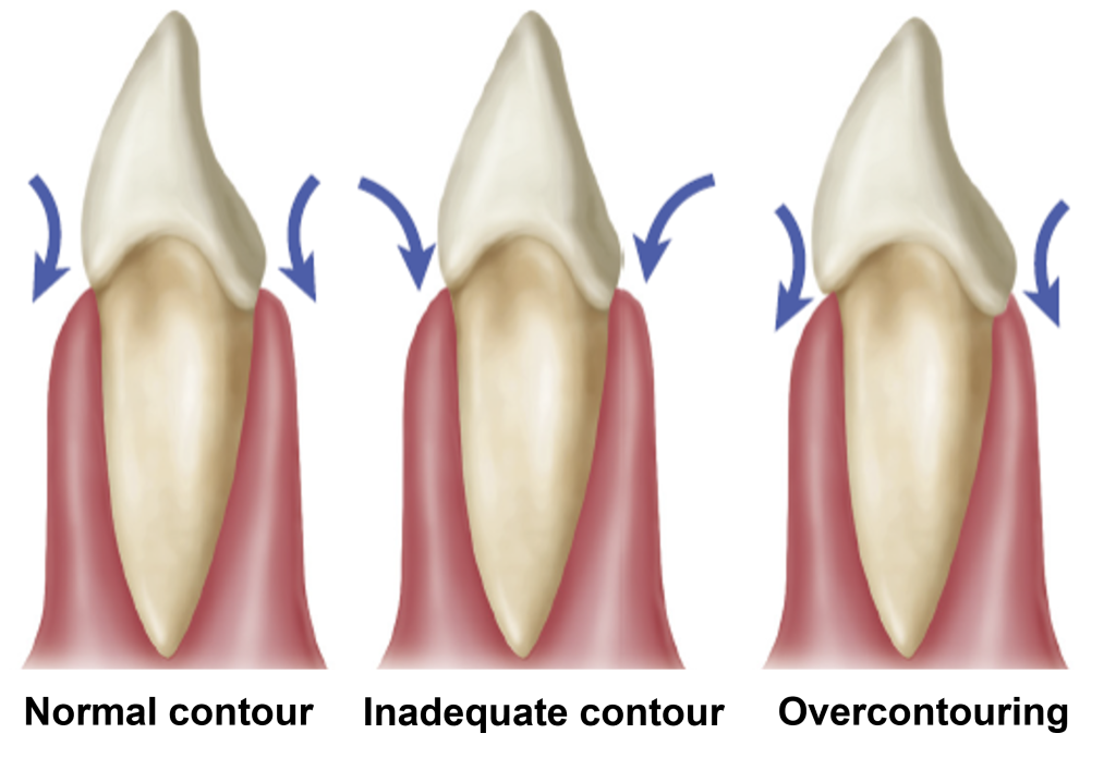 Illustration of three stages showing a tooth with directional arrows indicating the rotational movements of the crown in relation to the gingival tissue, demonstrating concepts of tooth contours and mobility.