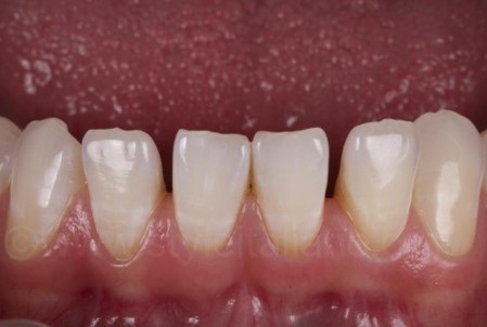 Close-up view of a person's front teeth showing varying degrees of translucency and slight misalignment.