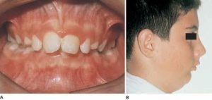 Two images showing Class II Division 1 dental malocclusion: A) A frontal view of an open mouth displaying misaligned teeth, and B) A side profile of a young male with his eye area blacked out for privacy.