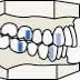 Simplified cartoon-style illustration of a human dental arch with a Class II Division 1 malocclusion, characterized by an overbite with upper teeth protruding significantly over the lower teeth.