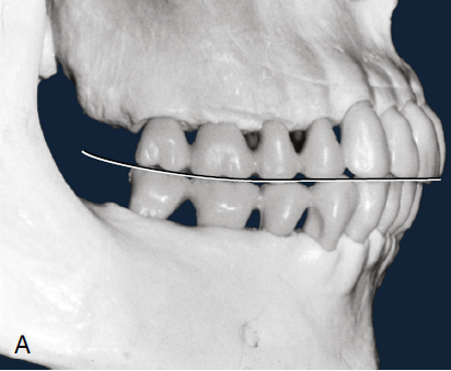 3D scan of a human skull showing the dental arch with teeth, featuring a line indicating the Curve of Spee which highlights the curvature of the occlusal surfaces of the molars and premolars.