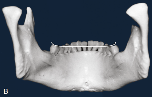 3D scan of a lower jaw model showing the dental arch from a frontal perspective with a wire illustrating the Curve of Wilson, which depicts the curvature across the tips of the molars.