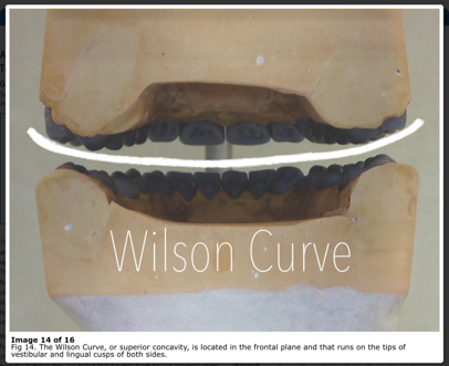 Dental model illustrating the Wilson Curve with a line across the occlusal surfaces of both the upper and lower dental arches, highlighting the superior concavity in the frontal plane.