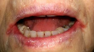 Close-up of a person's mouth showing dry, chapped lips with visible sores and damaged teeth.