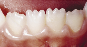 Close-up image of a person's lower teeth showing varying degrees of translucency and the presence of mamelons on the incisal edges.