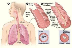 Images of airways of normal lungs vs asthmathic (with thickened artery wall)