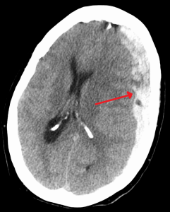 Scan of a brain showing a subdural hematoma