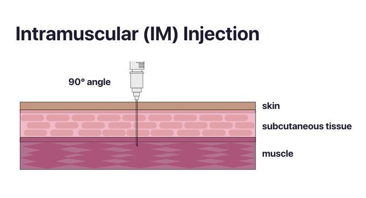 A 1” safety-engineered needle at a 90 degree angle to the skin, into the deltoid muscle. Epidermis layers labelled include skin, subcutaneous tissue, and muscle respectively.